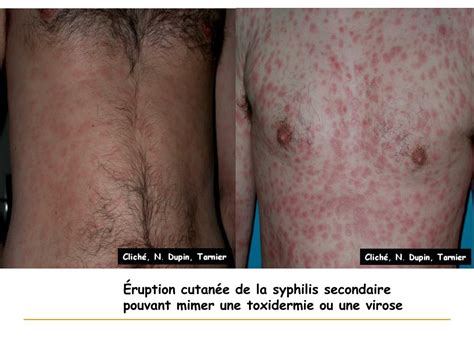 Ppt Syphilis Diagnostic Clinique 1 Powerpoint Presentation Free