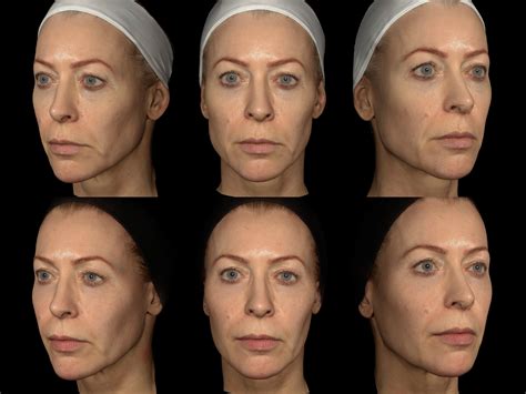 Can A Laser Tighten Jowls And Sagging Lower Lids The Tweakments Guide