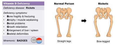 Rickets Symptoms And Causes Wifje
