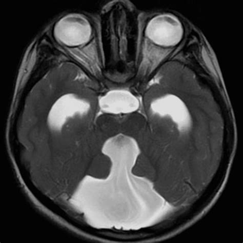 Brain Mri Plain Axial T2 Weighted Image Shows Dilated Fourth Ventricle