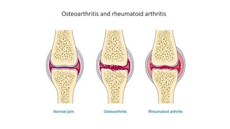 Rheumatoid Arthritis Physiopedia