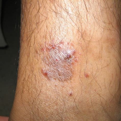 Eczema Atopic Dermatitis Dermboard