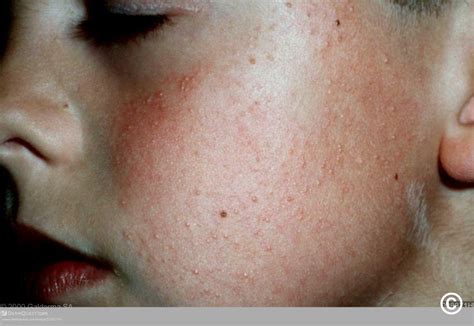 Facial Keratosis Pilaris Telegraph