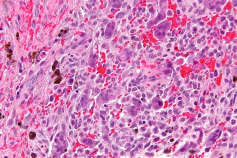 Filecentral Giant Cell Granuloma Very High Mag Wikipedia