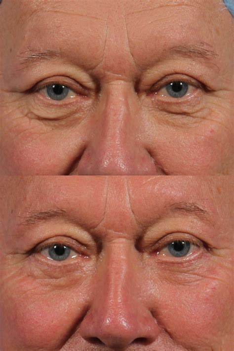 Cosmetic Oculoplastic Eyelid Lift Dr Brett Kotlus Cosmetic