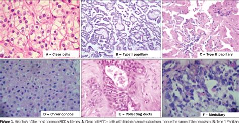 Figure 1 From Renal Cell Carcinoma Histological Classification And