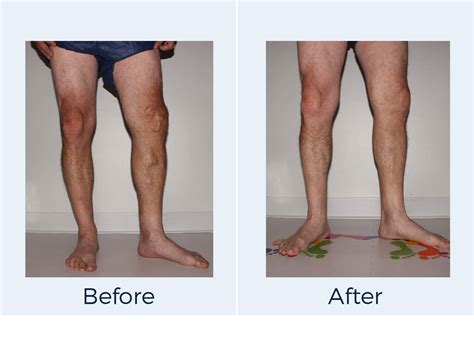 Vein Disease Treatment Before And After Photos American Vein And Vascular