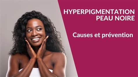 Hyperpigmentation Peau Noire Causes Et Prévention Youtube