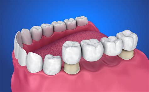 What Are The Benefits Of A Cosmetic Dental Bridge In Houston Blogs