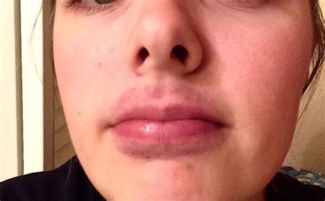 How To Get Rid Of A Bruised Lip Treat Swollen Lips