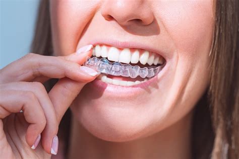 Invisalign Treatment From A General Dentist For Alignment Or Crowding