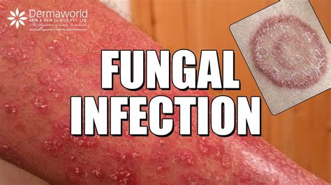 Suffering From Fungal Infection Ringworms Watch This Youtube