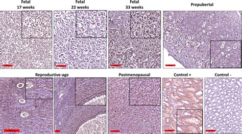 Immunohistochemical Staining Of PTCH1 In Fetal Prepubertal