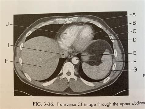 Fig 3 36 Transverse Ct Image Through The Upper Abdomen Diagram Quizlet