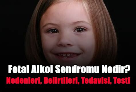 Fetal Alkol Sendromu Nedir Nedenleri Belirtileri Tedavisi Testi Hot