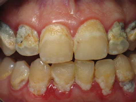 Kansas City Gingivitis And Periodontal Gum Disease Treatment