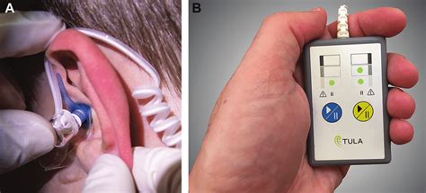 A Iontophoresis System Earset B Iontophoresis System Control Unit