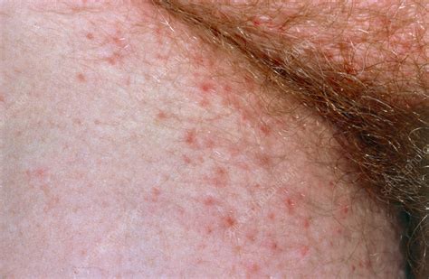 Scabies Infection Near The Groin Stock Image M2600097 Science