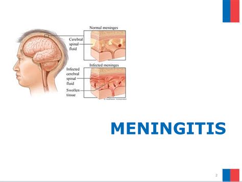 Informaci N Cuartos B Sicos Informaci N Meningitis