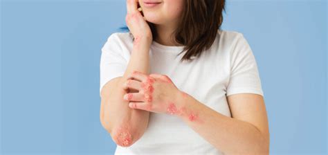 Whats The Difference Between Eczema Vs Psoriasis Dermal Therapy