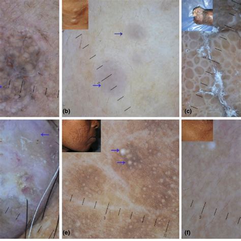 Clinical And Dermoscopic Details Of Benign Cutaneous Adnexal Tumours