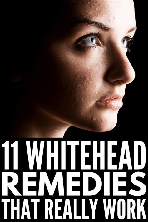 How To Get Rid Of Clogged Pores 11 Remedies And Products We Swear By Blackheads On Cheeks What