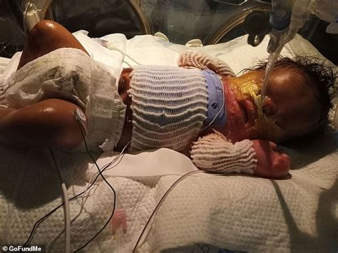 Three Month Old Baby Boy Born Without Skin Below The Neck Transferred