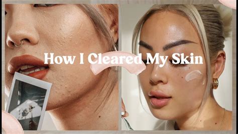 How I Cleared My Skin Acne And Acne Scars Skincare Tips Lifestyle