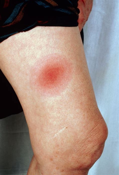 Image A Variation Of The Rash Of Lyme Disease Erythema Migrans