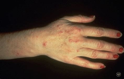 How to treat eczema on your hands? What to Do If Your Hands Are a Mess From Washing Them So Much!