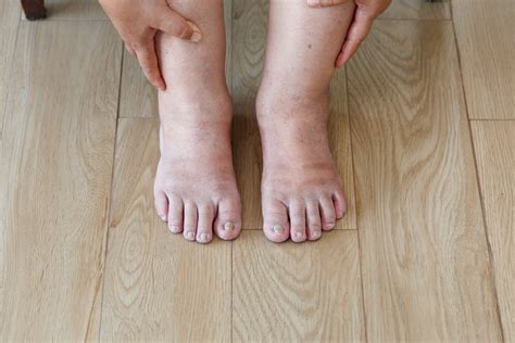 10 Causes For Swollen Feet Why Your Feet Ankles Legs