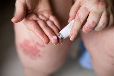 5 Types Of Plaque Psoriasis And Their Treatment Options The Frisky