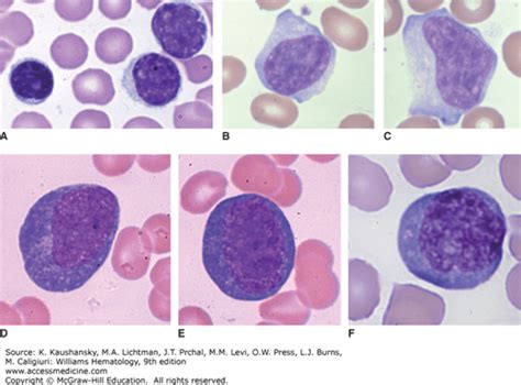 Lymphocytosis And Lymphocytopenia Oncohema Key