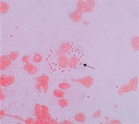 Днк гонококка (neisseria gonorrhoeae), количественно. Gram-Negative Cocci - Review of Medical Microbiology and ...
