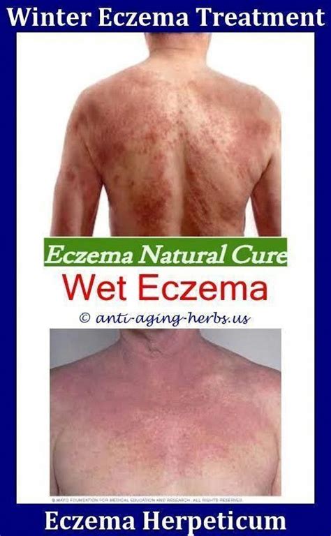 Eczema On Scalp Nummular Eczema Dietfollicular Eczema Eczema Fluid
