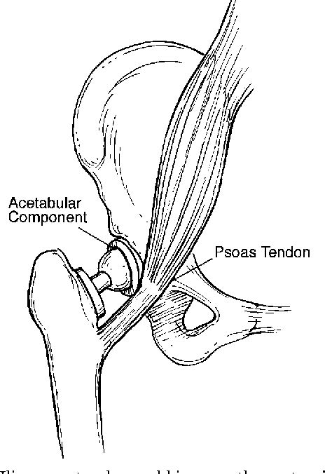 Surgical Release Of Iliopsoas Tendon For Groin Pain After Total Hip