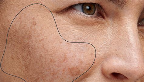 What Causes Uneven Skin Tone — Dermalogica Au