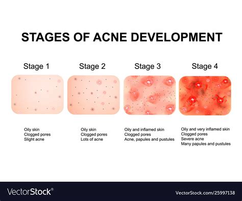 Stages Development Acne Inflamed Skin Royalty Free Vector