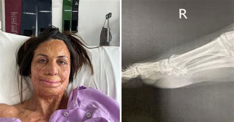 Turia Pitt Exclusive Turia Pitt Hospitalised After Unbearably Painful Accident In Hotel Room