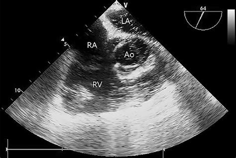 Midesophageal Right Ventricle Inflow Outflow View Of The Download