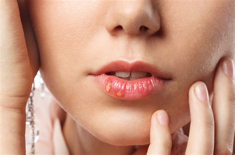 Itchy Small Red And White Bumps On Lips Reasons And Treatment