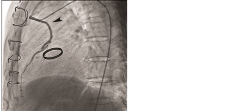 Iatrogenic Disruption Of Left Main Coronary Artery During Aortic Valve