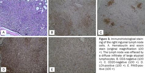 Figure 3 From Cd20 Negative Diffuse Large B Cell Lymphoma Presenting