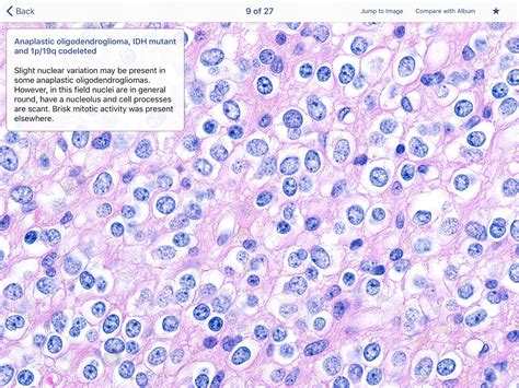 Neuropathology Blog Screenshots Of The Surgical Neuropathology Volume