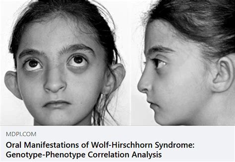 El Síndrome De Wolf Hirschhorn Una Enfermedad Para Tomar En Cuenta Diario Salud