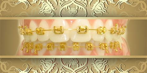 The cost of braces without. Gold Braces in Houston | Sugar Land TX