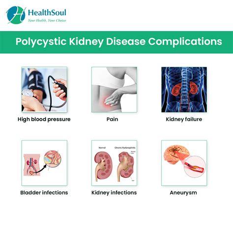 Polycystic Kidney Disease Symptoms Diagnosis And Treatment Healthsoul