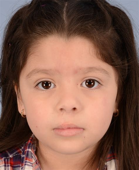 Cleft Lip And Palate Repair Before And After Photos By Christopher Derderian Md Dallas Tx