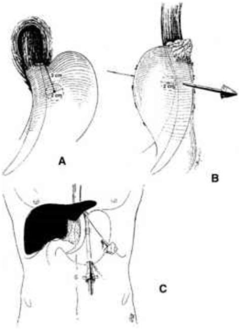 open laparotomy  reoperative fundoplication reflux