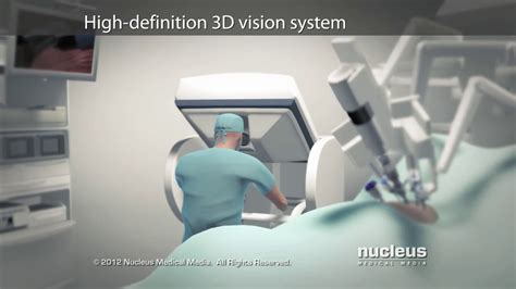 Robotic Radical Prostatectomy Da Vinci Animation YouTube
